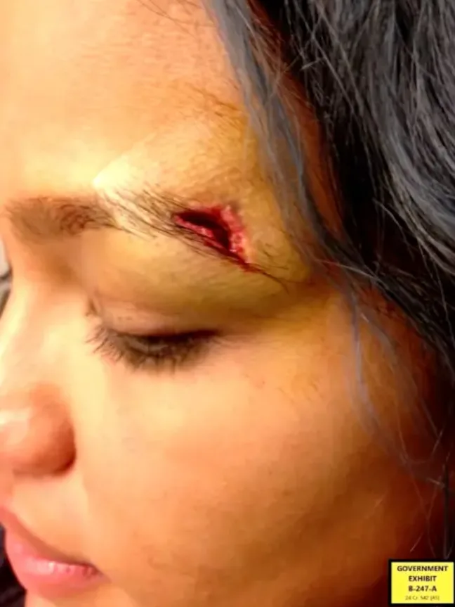 Graphic Photos Reveal Cassie Ventura’s Bruises from Diddy’s Abuse